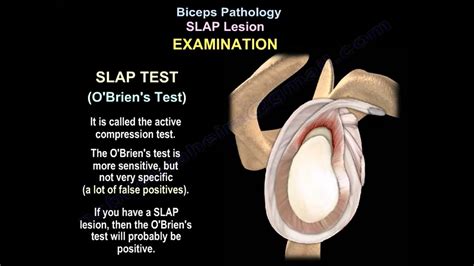 slap lesion physical diagnosis